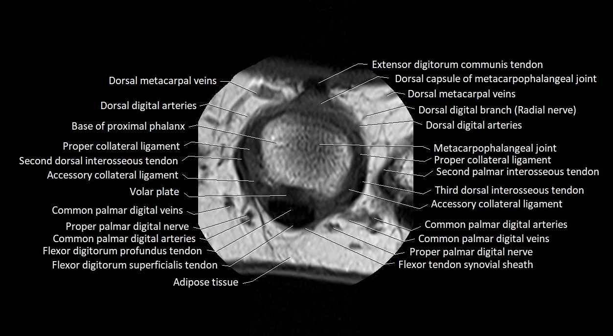 Finger anatomy axial cross sectional 3T image image 22.webp